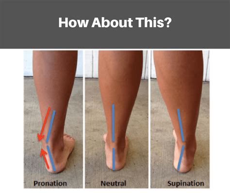 pronation vs supination running.